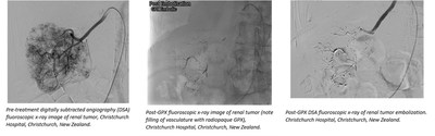 Innovative Embolic Device for Treating Tumors Highlighted in "BEST of GEST" Session at the Global Embolization Oncology Symposium Technologies ("GEST") Conference