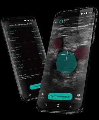 Los resultados del software de detección de TVP ThinkSono se publican en Nature Digital Medicine (npj)