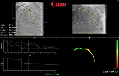 El software "CAAS vFFR" de Pie Medical Imaging es objeto del ensayo FAST III