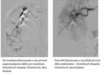 GPX Embolic Device Success in Challenging Tumor Case