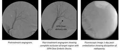 Fluidx Medical's Embolic Demonstrates Novel Visibility Advantage