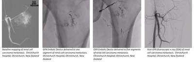 Metastatic Tumor Treatment with Novel GPX Embolic Device