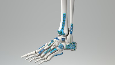 Medline UNITE launches Calcaneal Fracture Plating System and IM Fibula Implant