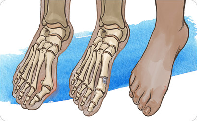 Bunion Treatment Takes a Leap Forward: New, No-Fusion Active Bunion Surgery is Simple, Fast & Improves on Other Options