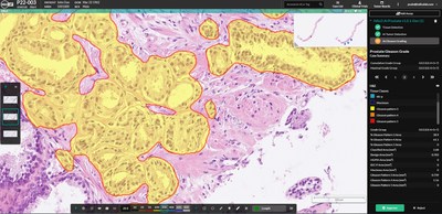Indica Labs achieves CE-IVD certification for AI-based Prostate Cancer Detection and Gleason Grading Tool