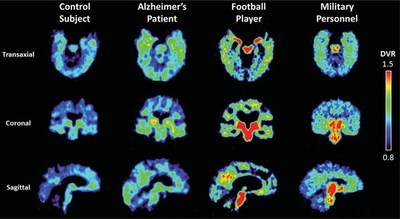Patent Award Notice: PET Scan Imaging Agent Detects both Tau Aggregates and Beta Amyloid Plaque Simultaneously