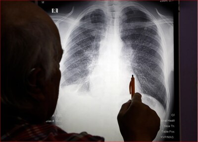 Brayton Purcell LLP responde a la investigación de CBS News sobre la rápida escalada de la crisis de silicosis entre los trabajadores de la fabricación de piedra artificial